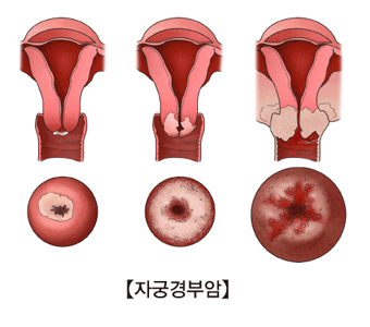 자궁경부암 증상